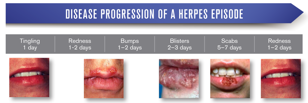 the-stages-of-a-cold-sore-breakout